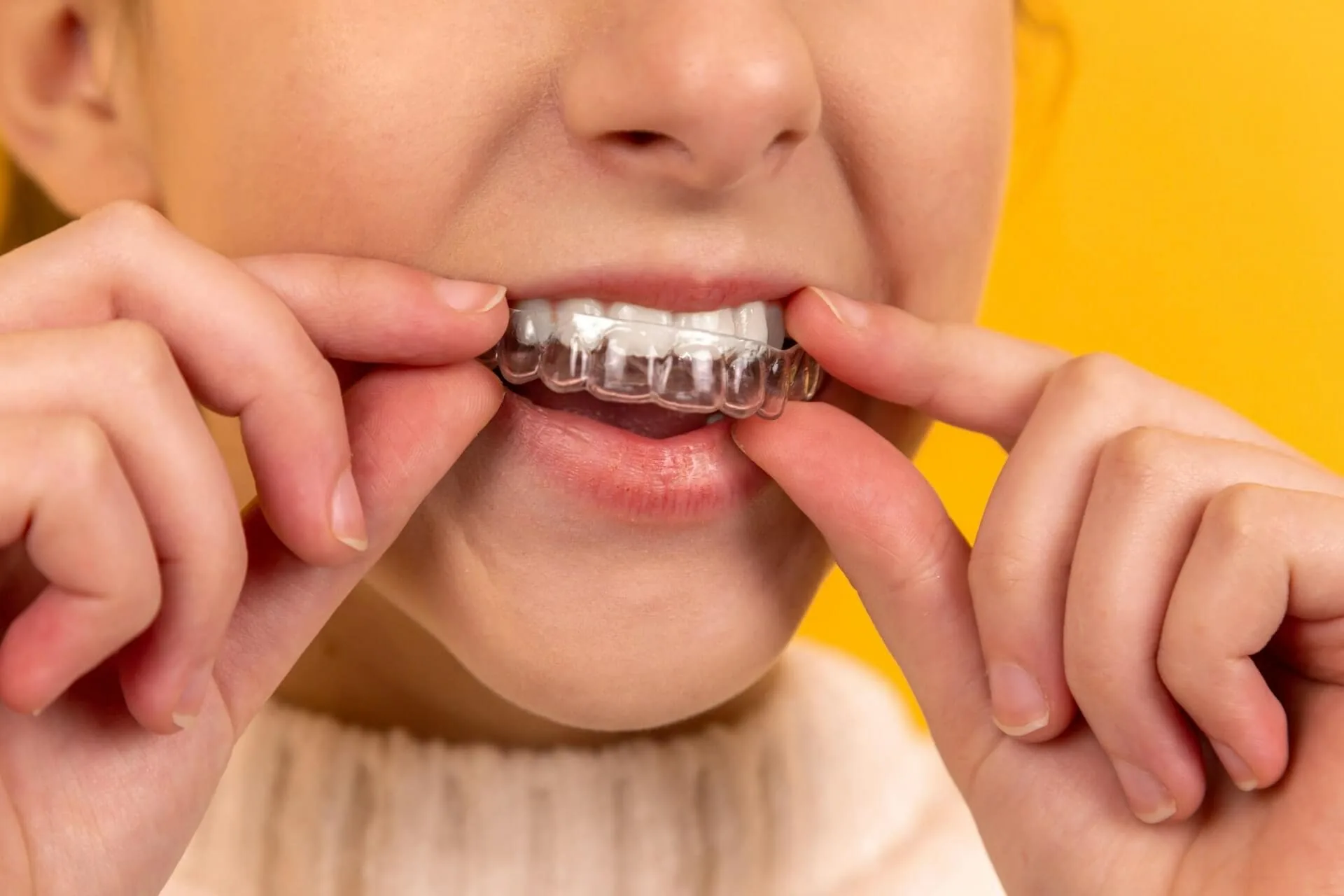 Person placing a clear aligner over their teeth, demonstrating Invisalign-style orthodontic treatment.