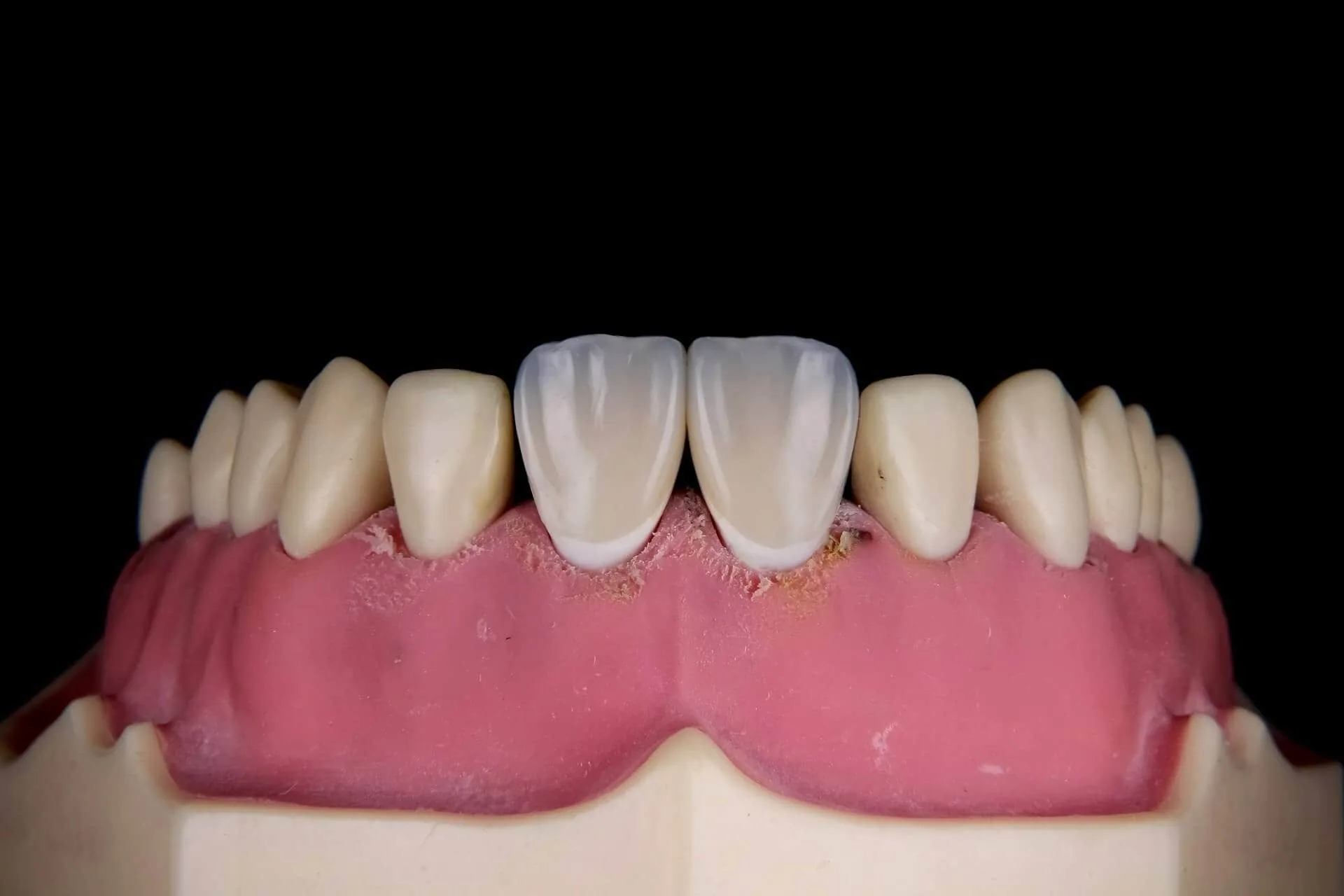 A set of bottom teeth with gums