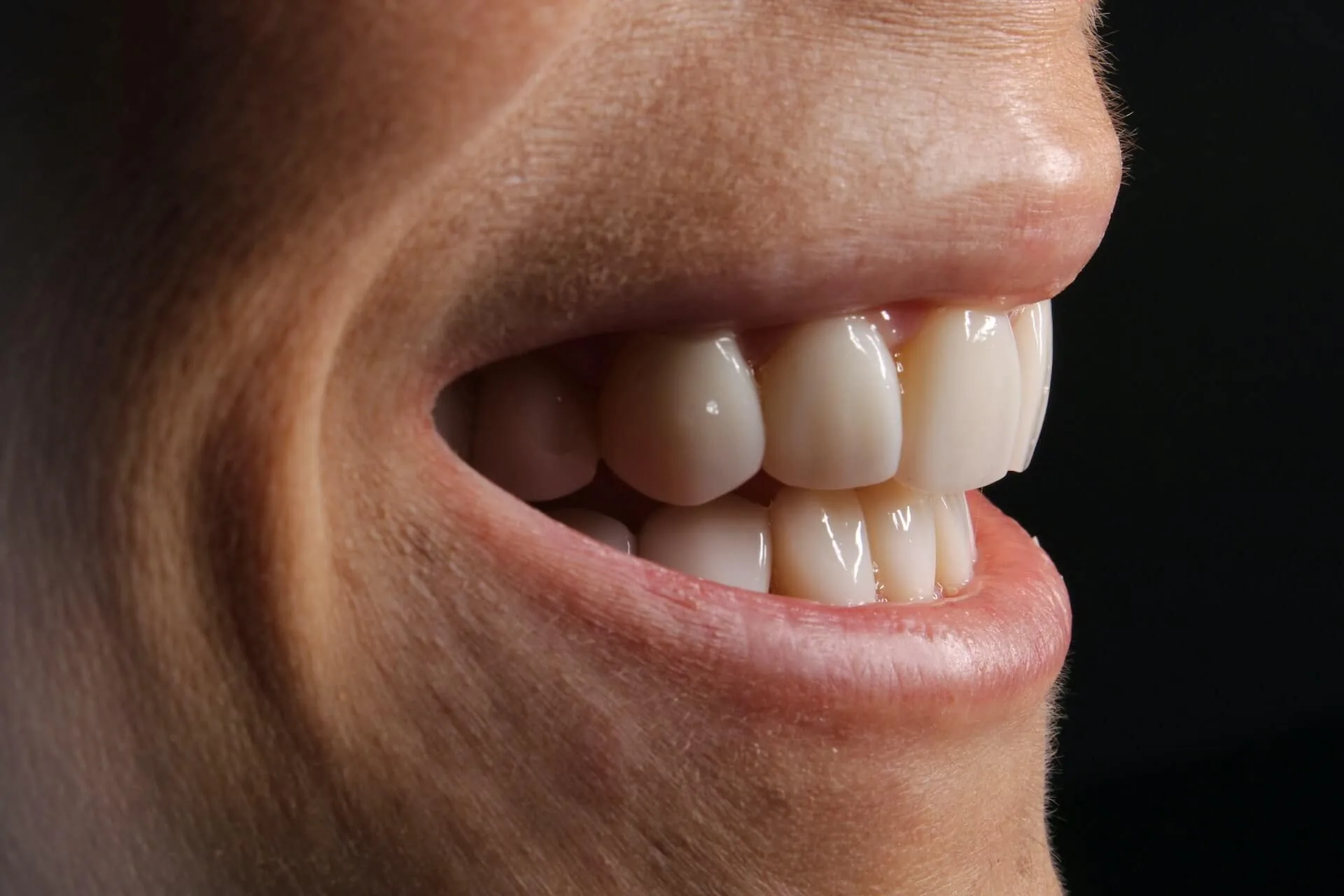 cosmetic consultation for veneers