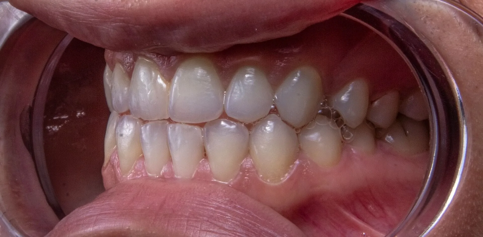 A close up photo of a person's teeth