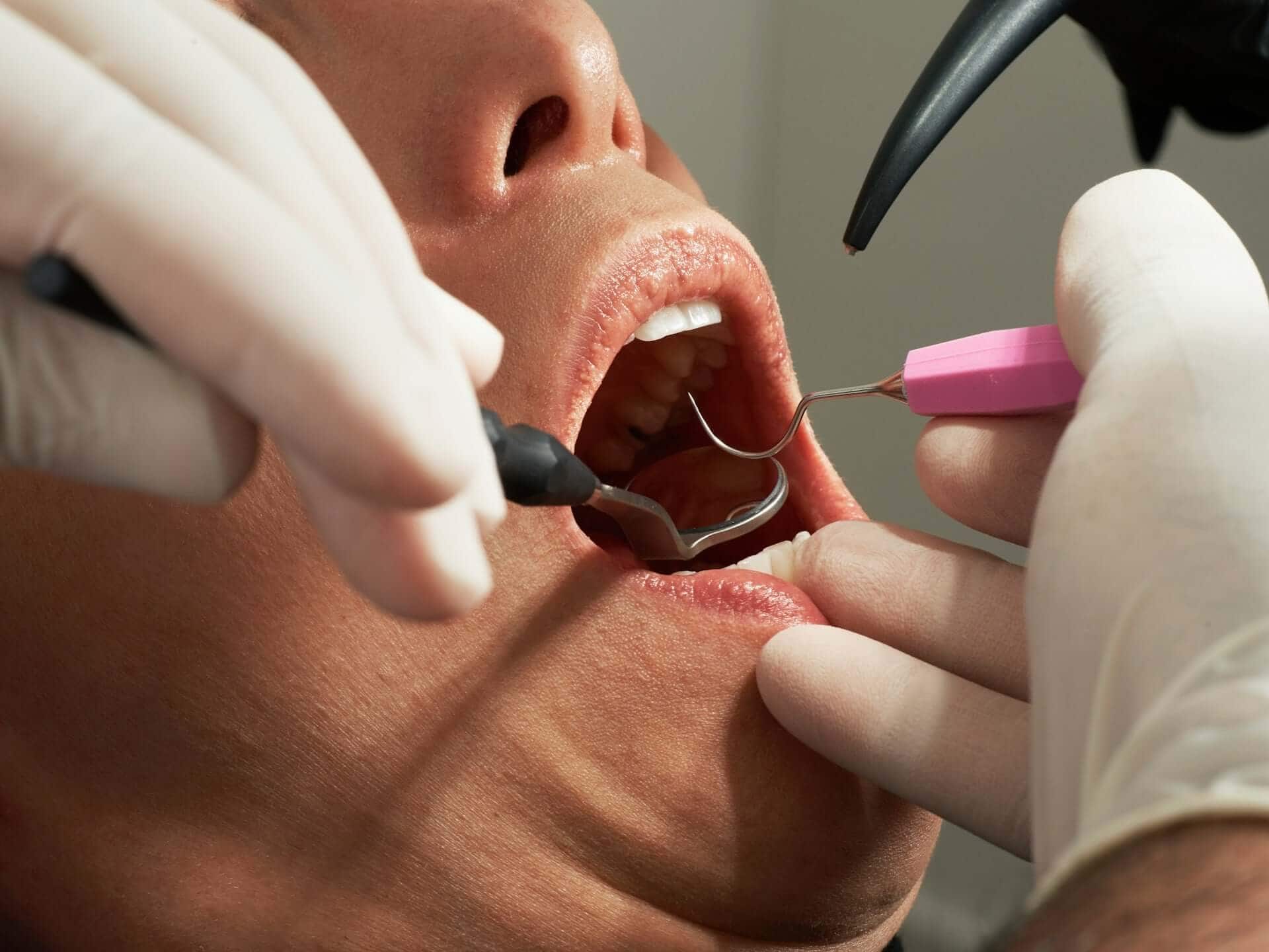 Early Signs of Gum Disease
