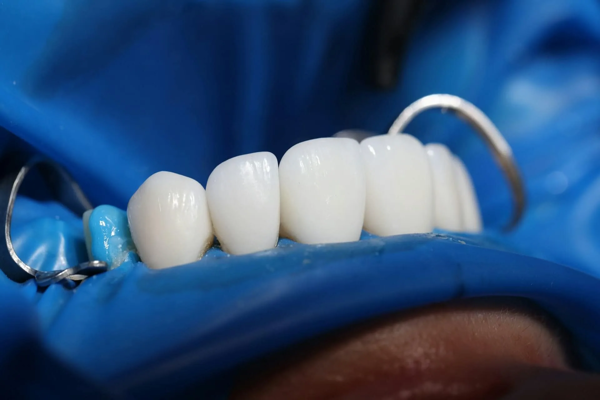 A close up of a bottom part of the teeth