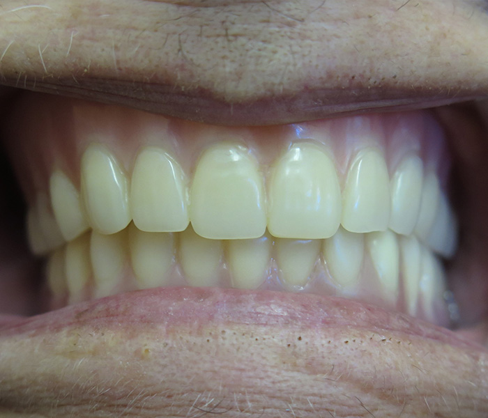 Dental Implant After 1