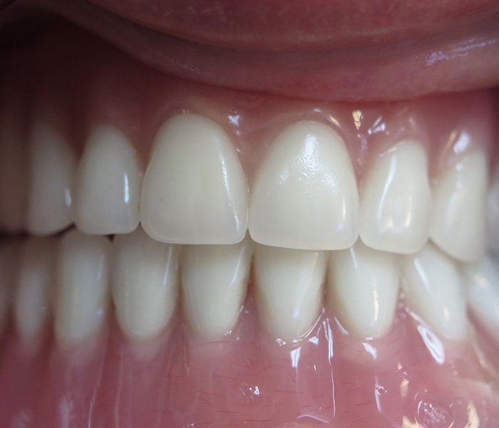 Dental Implant After 2