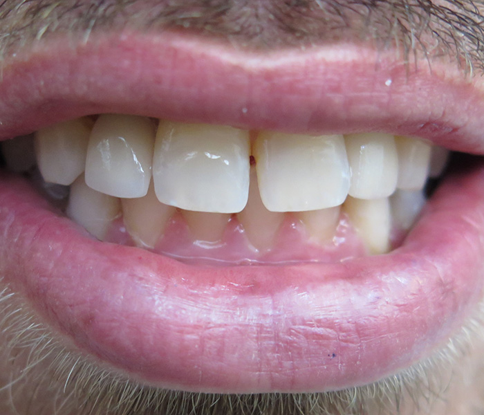 Dental Implant After 3