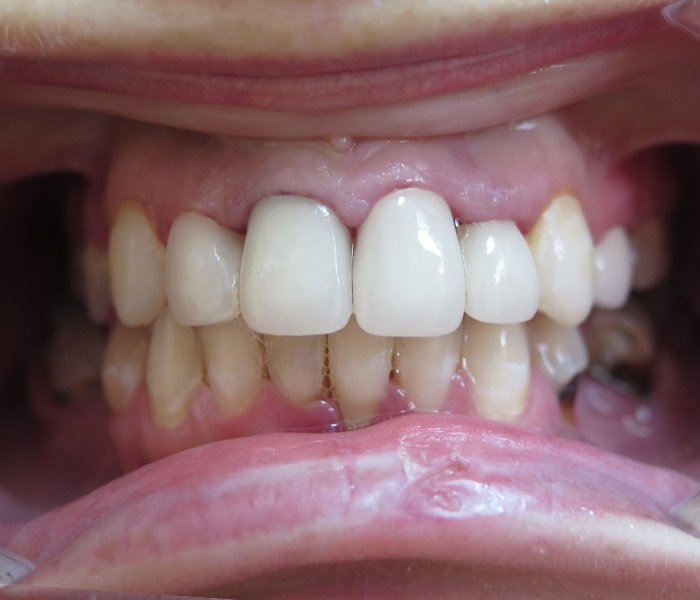 Dental Implant After 5