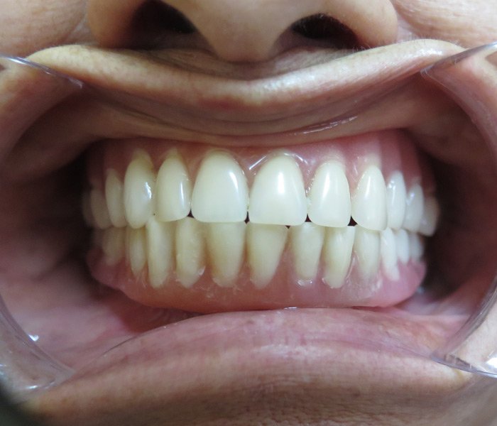 Dental Implant After 6