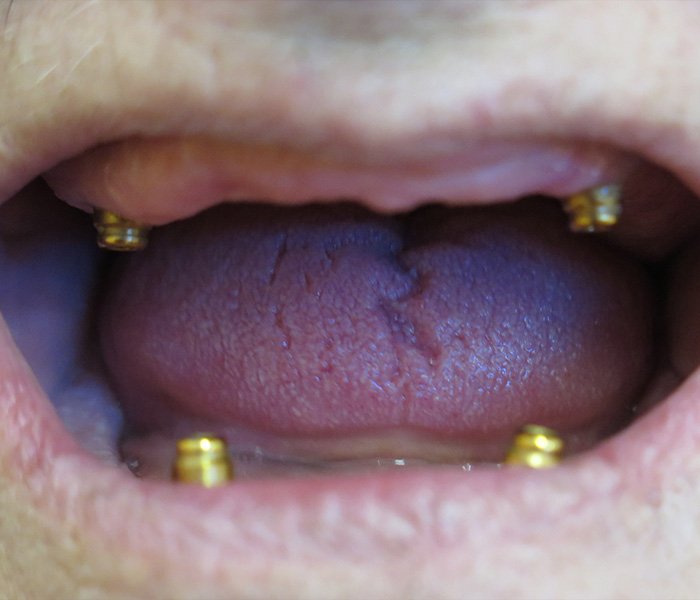 Dental Implant Before 1