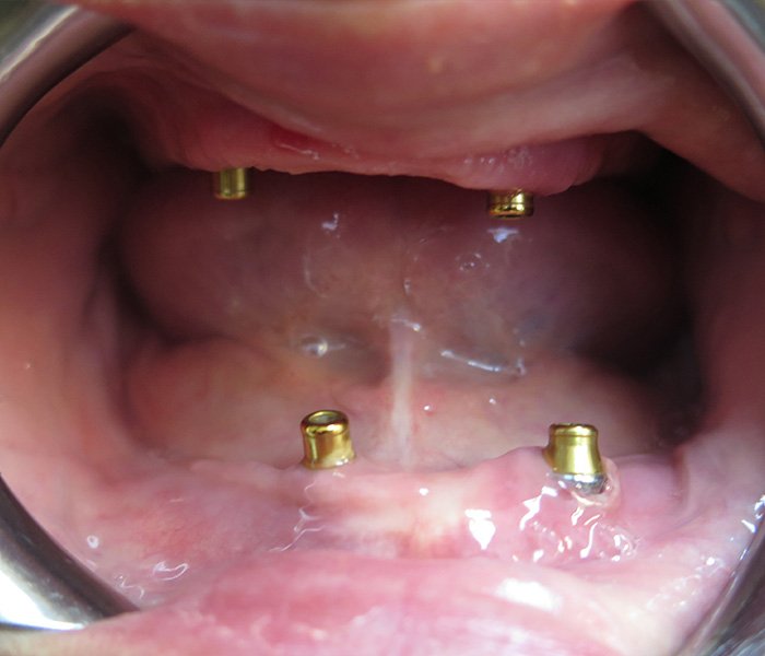 Dental Implant Before 2