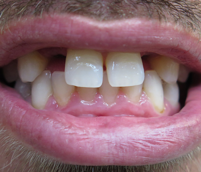 Dental Implant Before 3