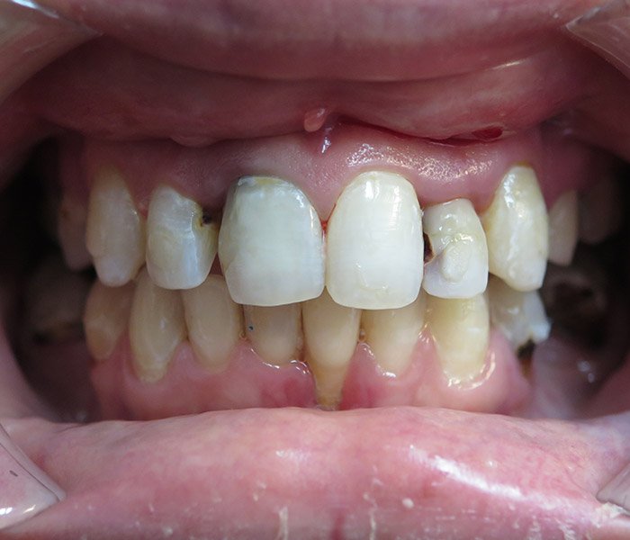 Dental Implant Before 5