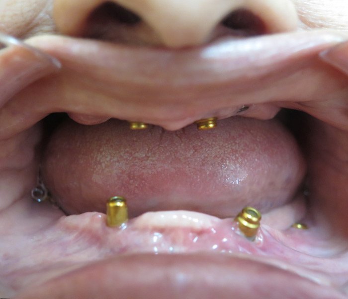 Dental Implant Before 6